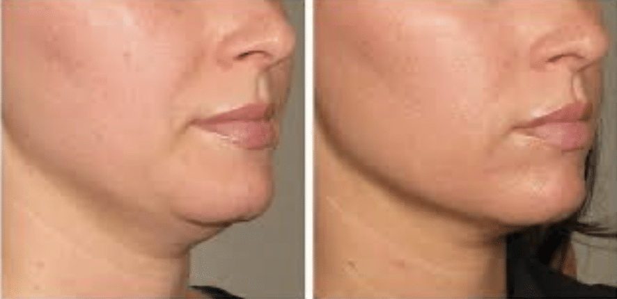 Laser Sculpting Chin