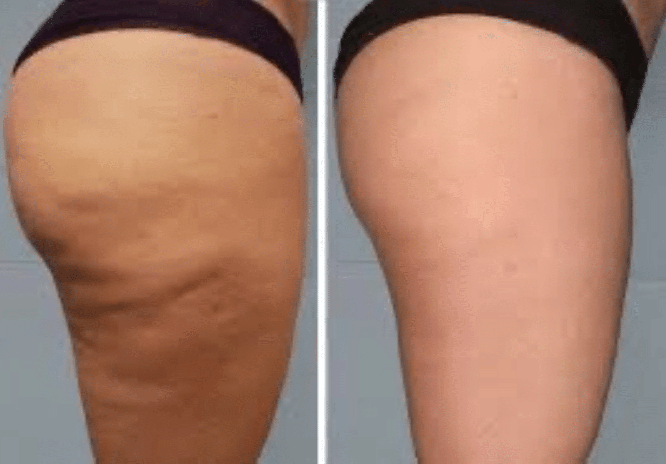 Laser Sculpting Thighs